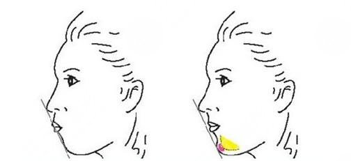 廣州荔灣醫(yī)院取出案例反饋