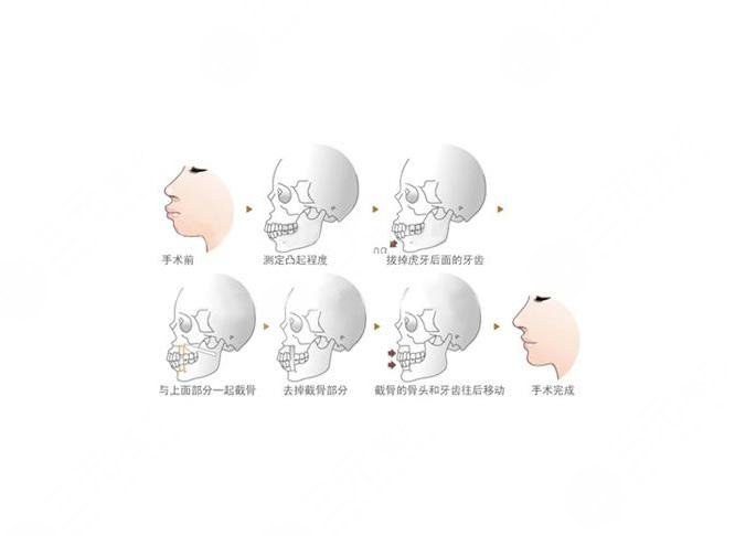 番禺中心醫(yī)院口腔科牙齒矯正案例|網友親身經歷:術前