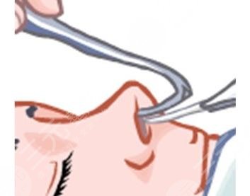 隆鼻1-7天恢復(fù)過程圖