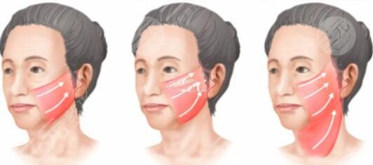 光電提拉果維持多久？教你這樣做可以延長維持時間，爆肝攻略趕緊收藏~