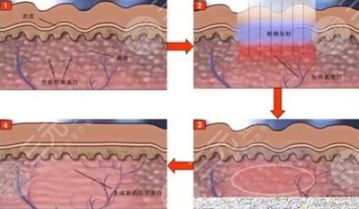 光電提拉果維持多久？