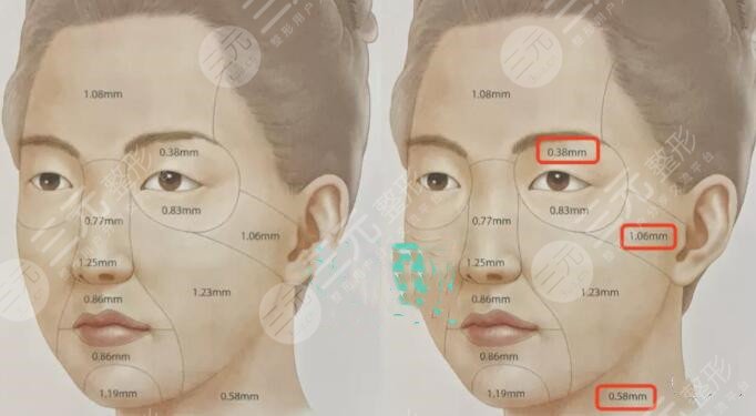 真人體驗光電提拉案例