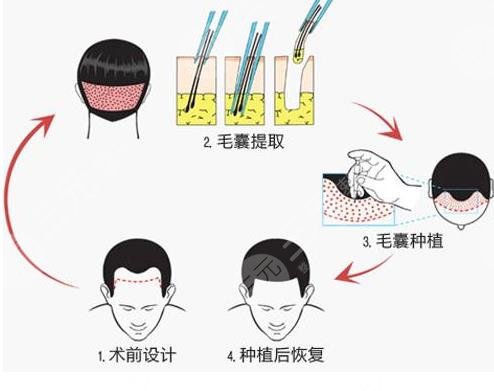 成都植發(fā)費(fèi)用一般多少