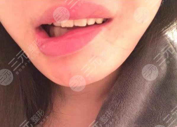 女子整容失敗嘴巴歪，花一年多時(shí)間緩解！整形醫(yī)院只退3.5萬(wàn)手術(shù)費(fèi)！