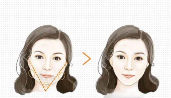 圓臉怎樣變瓜子臉