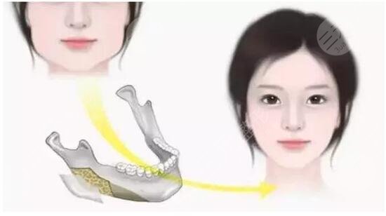 磨骨手術(shù)有什么風(fēng)險(xiǎn)和后遺癥？教你如何避坑降低風(fēng)險(xiǎn)變美？