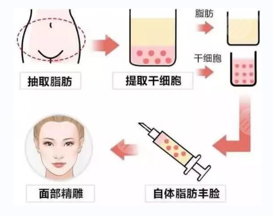 什么是脂肪面部填充