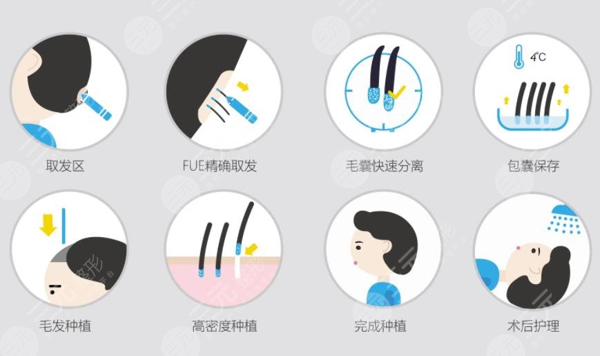 種植頭發(fā)手術(shù)案例