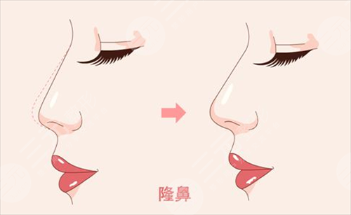 人工骨隆鼻吸收率是多少？手術(shù)前后需要注意的事項(xiàng)