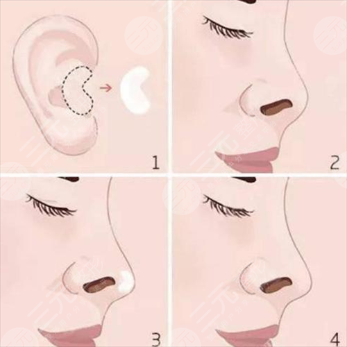 自體軟骨隆鼻注意事項有哪些