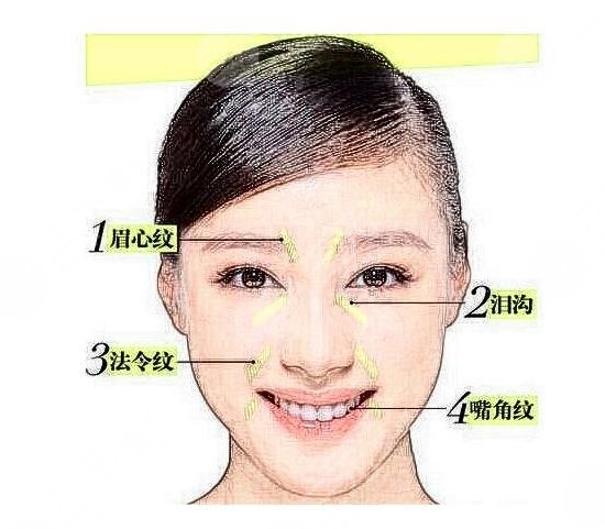 玻尿酸去除法令紋好嗎