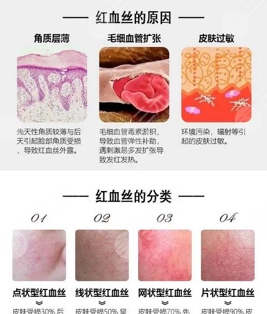 紅血絲應該怎樣預防