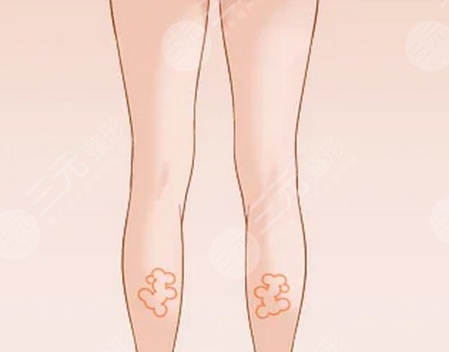 ****注射瘦腿降低風(fēng)險嗎