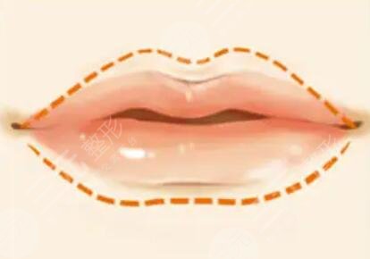 紋唇一到七天恢復(fù)圖片真實(shí)過(guò)程：好唇色襯托好氣色！早上出門(mén)節(jié)約幾分鐘！