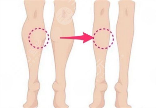 注射瘦腿有嗎 注射注射瘦腿前后對比圖