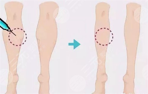 注射瘦腿有嗎 注射注射瘦腿前后對比圖