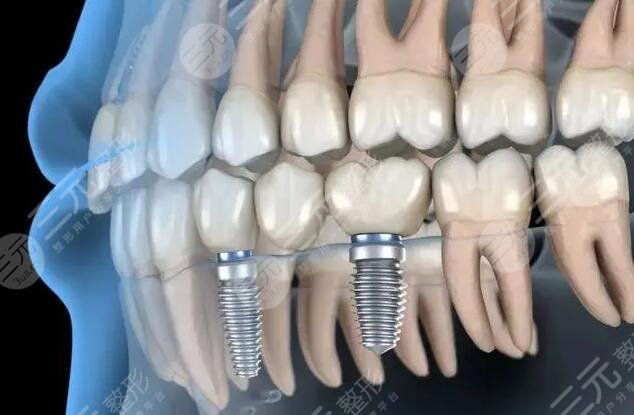 山大一院牙科牙齒種植案例