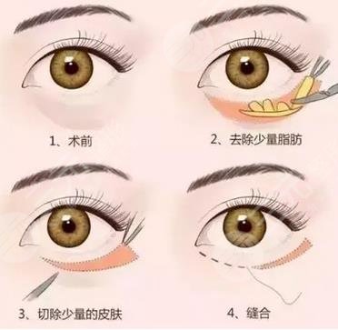 超聲波去眼袋原理