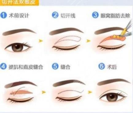 女子割雙眼皮殞命手術(shù)臺