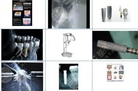 德國(guó)費(fèi)亞丹種植體