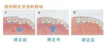 牙齒矯正過程