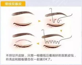 埋線雙眼皮