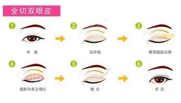雙眼皮過程
