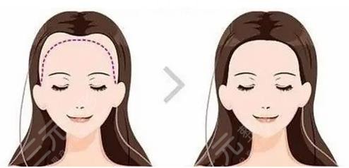 發(fā)際線種植果