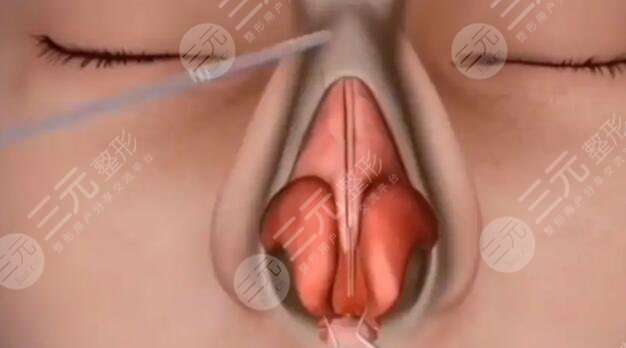 假體隆鼻術(shù)后一周恢復(fù)