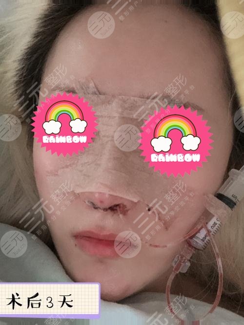 隆鼻前后對(duì)比果圖片