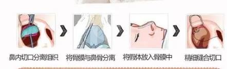 超體隆鼻的注意事項