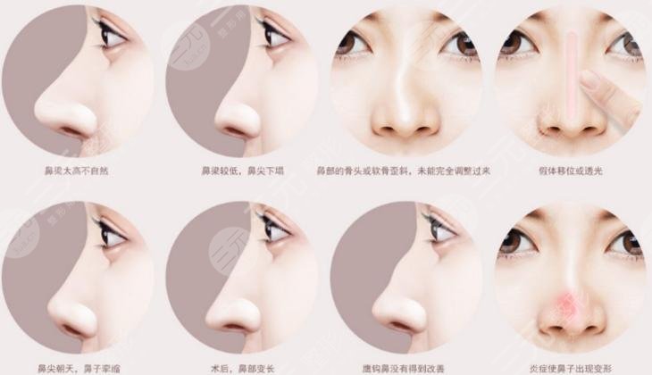 假體取出后如何護(hù)理