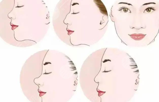 假體取出后如何護(hù)理