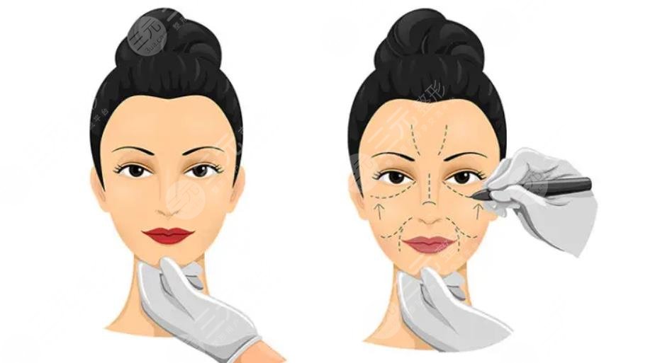 大拉皮手術(shù)大概多少錢