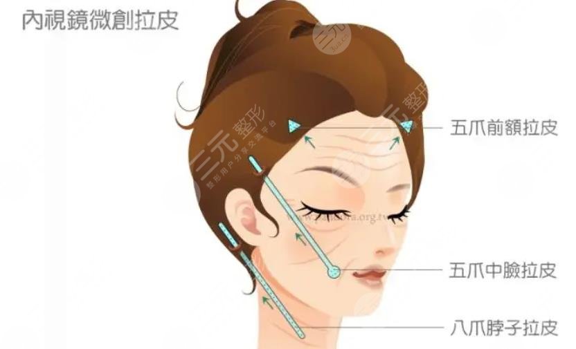 小切口拉皮手術(shù)對(duì)比照片