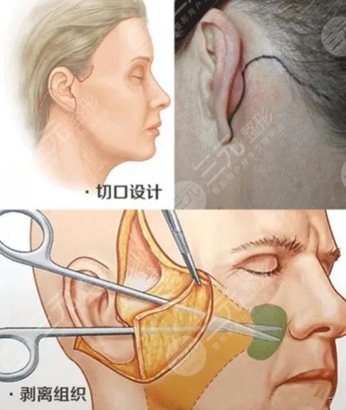做小拉皮手術(shù)需要多少錢(qián)