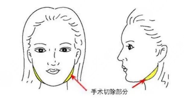 華西和友誼磨骨哪個貴