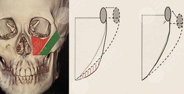 磨顴骨有風(fēng)險嗎？
