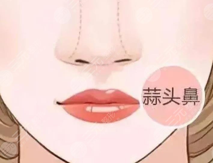 蒜頭鼻縮小手術(shù)多少錢