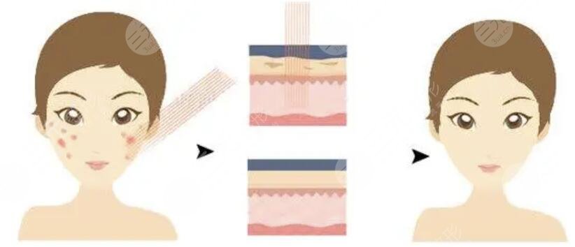 點(diǎn)陣激光后恢復(fù)過程圖