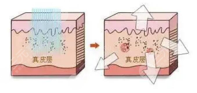 點(diǎn)陣激光后恢復(fù)原理