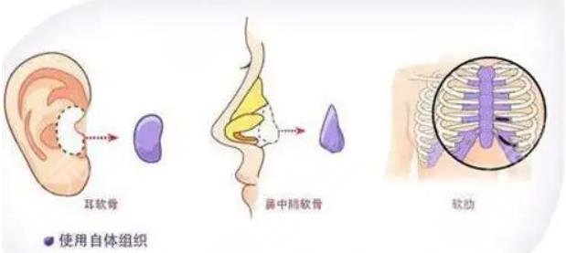 自體軟骨隆鼻有哪些優(yōu)缺點(diǎn)