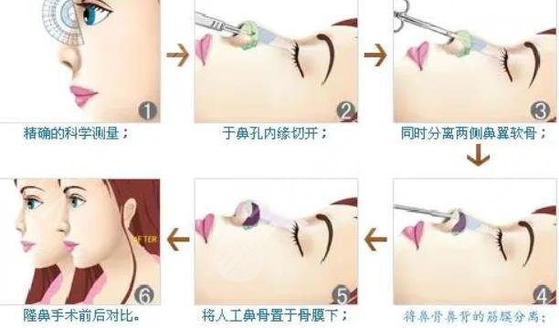 自體軟骨隆鼻有哪些優(yōu)缺點(diǎn)