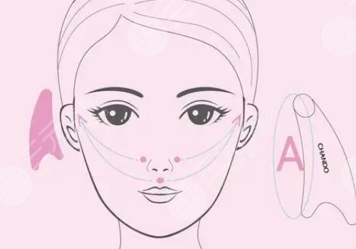 v-line瓜子臉手術注意事項