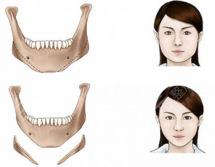 v-line瓜子臉手術是磨骨嗎