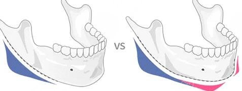 V-line瓜子臉的優(yōu)勢