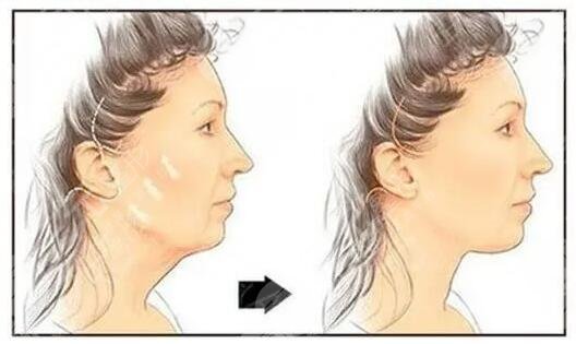 自身因素影響了冰電波拉皮的價(jià)格