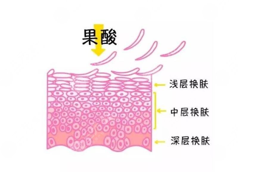 果酸換膚案例：果酸換膚前后對(duì)比照片曝光