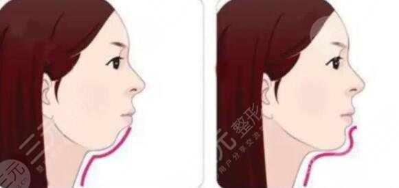 下巴打玻尿酸一周變化圖