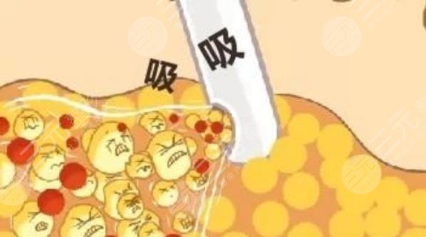 鄭州人民醫(yī)院整形科吸脂瘦身案例分享